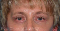 Endoscopic Brow Lift