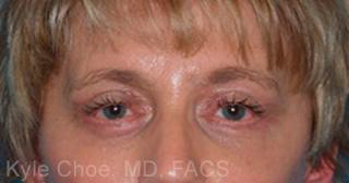 Endoscopic Brow Lift