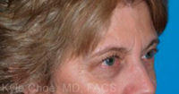 Endoscopic Brow Lift