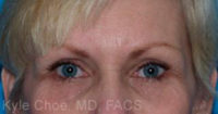 Endoscopic Brow Lift