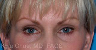 Endoscopic Brow Lift