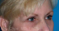 Endoscopic Brow Lift