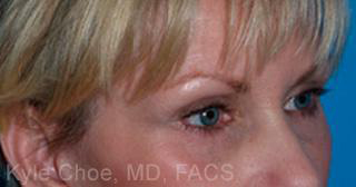 Endoscopic Brow Lift