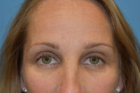 Endoscopic Brow Lift