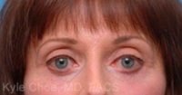 Endoscopic Brow Lift