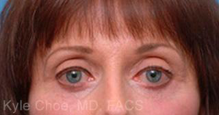 Endoscopic Brow Lift