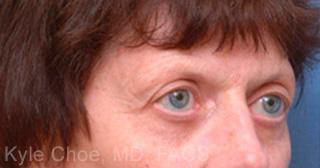 Endoscopic Brow Lift