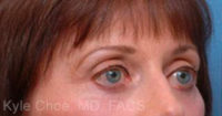 Endoscopic Brow Lift