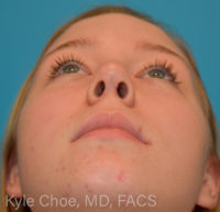 Rhinoplasty