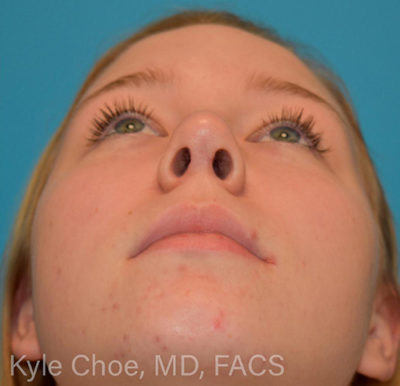 Rhinoplasty