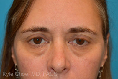 Blepharoplasty (Eyelid Surgery)