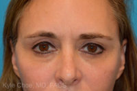 Blepharoplasty (Eyelid Surgery)