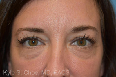 Blepharoplasty (Eyelid Surgery)