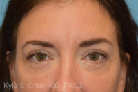 Blepharoplasty (Eyelid Surgery)