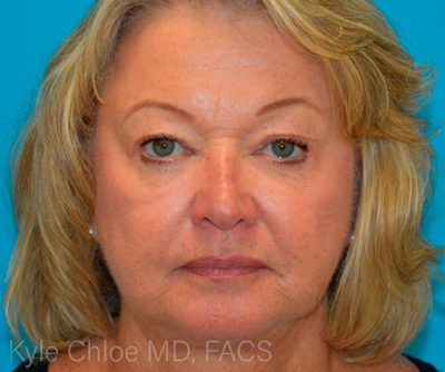 Blepharoplasty (Eyelid Surgery)