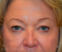 Blepharoplasty (Eyelid Surgery)