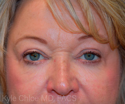 Blepharoplasty (Eyelid Surgery)