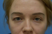 Blepharoplasty (Eyelid Surgery)