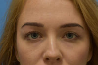 Blepharoplasty (Eyelid Surgery)