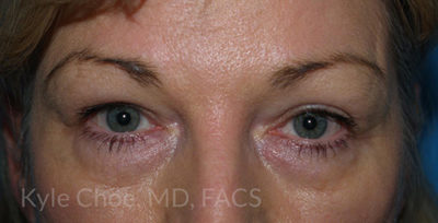 Blepharoplasty (Eyelid Surgery)