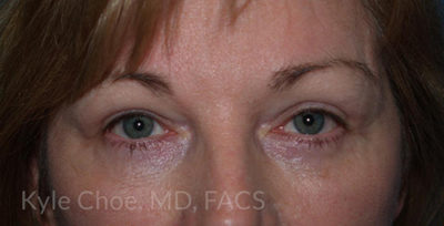 Blepharoplasty (Eyelid Surgery)