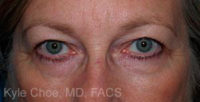 Blepharoplasty (Eyelid Surgery)