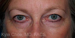 Blepharoplasty (Eyelid Surgery)