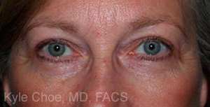 Blepharoplasty (Eyelid Surgery)