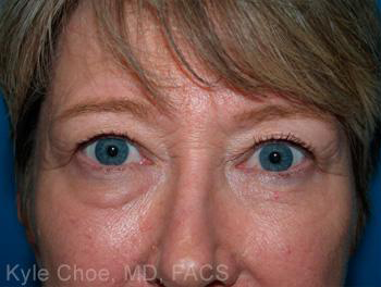 Blepharoplasty (Eyelid Surgery)