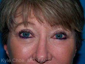 Blepharoplasty (Eyelid Surgery)