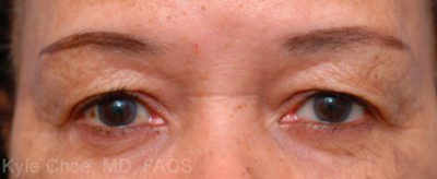 Blepharoplasty (Eyelid Surgery)