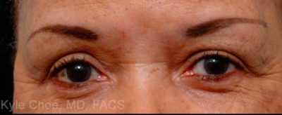 Blepharoplasty (Eyelid Surgery)