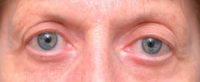 Blepharoplasty (Eyelid Surgery)