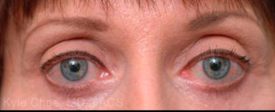 Blepharoplasty (Eyelid Surgery)