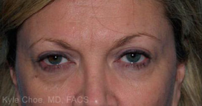 Blepharoplasty (Eyelid Surgery)