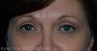 Blepharoplasty (Eyelid Surgery)