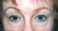 Blepharoplasty (Eyelid Surgery)