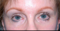 Blepharoplasty (Eyelid Surgery)