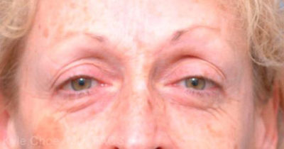 Blepharoplasty (Eyelid Surgery)