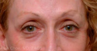 Blepharoplasty (Eyelid Surgery)