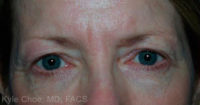 Blepharoplasty (Eyelid Surgery)