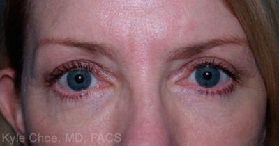 Blepharoplasty (Eyelid Surgery)