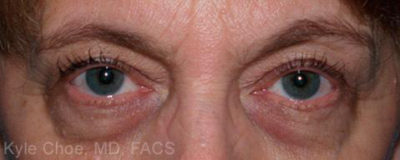 Blepharoplasty (Eyelid Surgery)