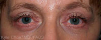 Blepharoplasty (Eyelid Surgery)