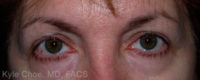 Blepharoplasty (Eyelid Surgery)