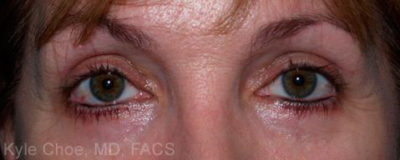 Blepharoplasty (Eyelid Surgery)