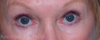 Blepharoplasty (Eyelid Surgery)