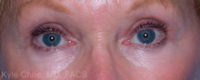 Blepharoplasty (Eyelid Surgery)