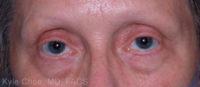 Blepharoplasty (Eyelid Surgery)