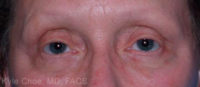 Blepharoplasty (Eyelid Surgery)